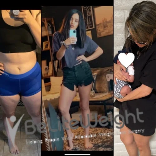 Weight Loss Surgery Before And After Devon F - 2 Year Update*